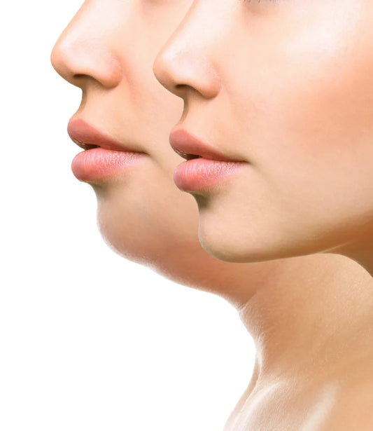 How Long Does It Take For Kybella To Heal Fully?