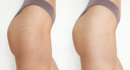 Stretch Mark Revision: Everything You Need to Know