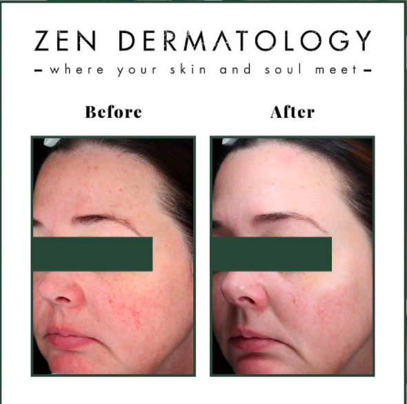 IPL Treatments before & after image by ZEN Dermatology in Sacramento, CA