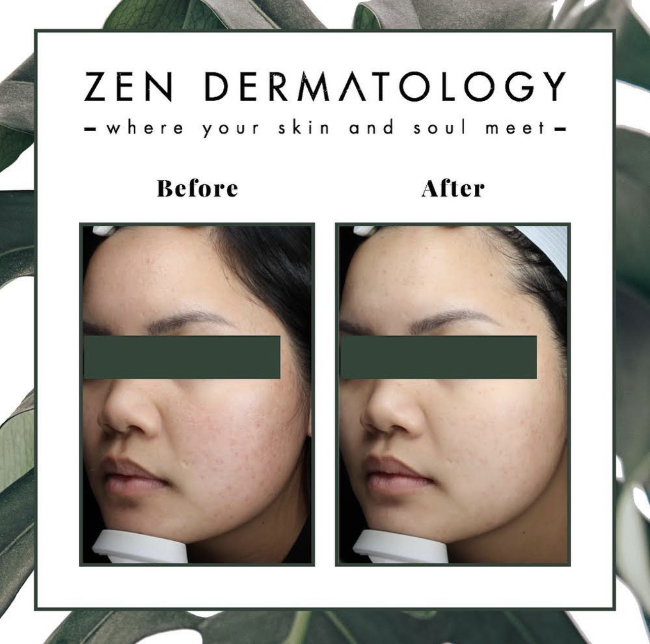 microneedling_skinpen before & after image by ZEN Dermatology in Sacramento, CA