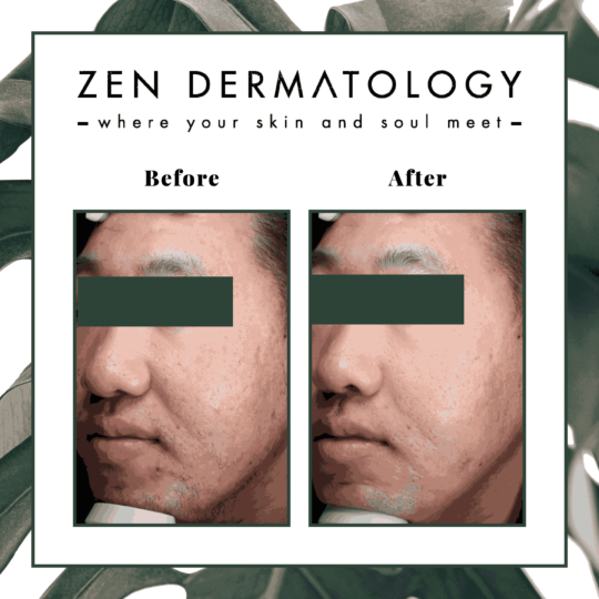 RF_Microneedling before & after images by ZEN Dermatology in Sacramento, CA