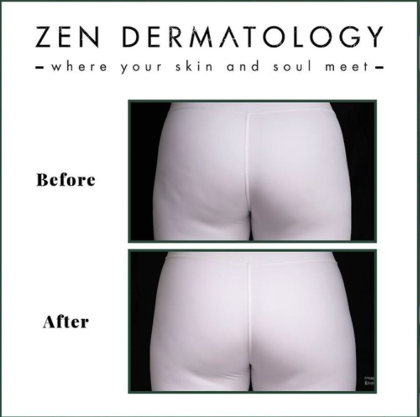 QWO_treatments by ZEN Dermatology in Sacramento, CA