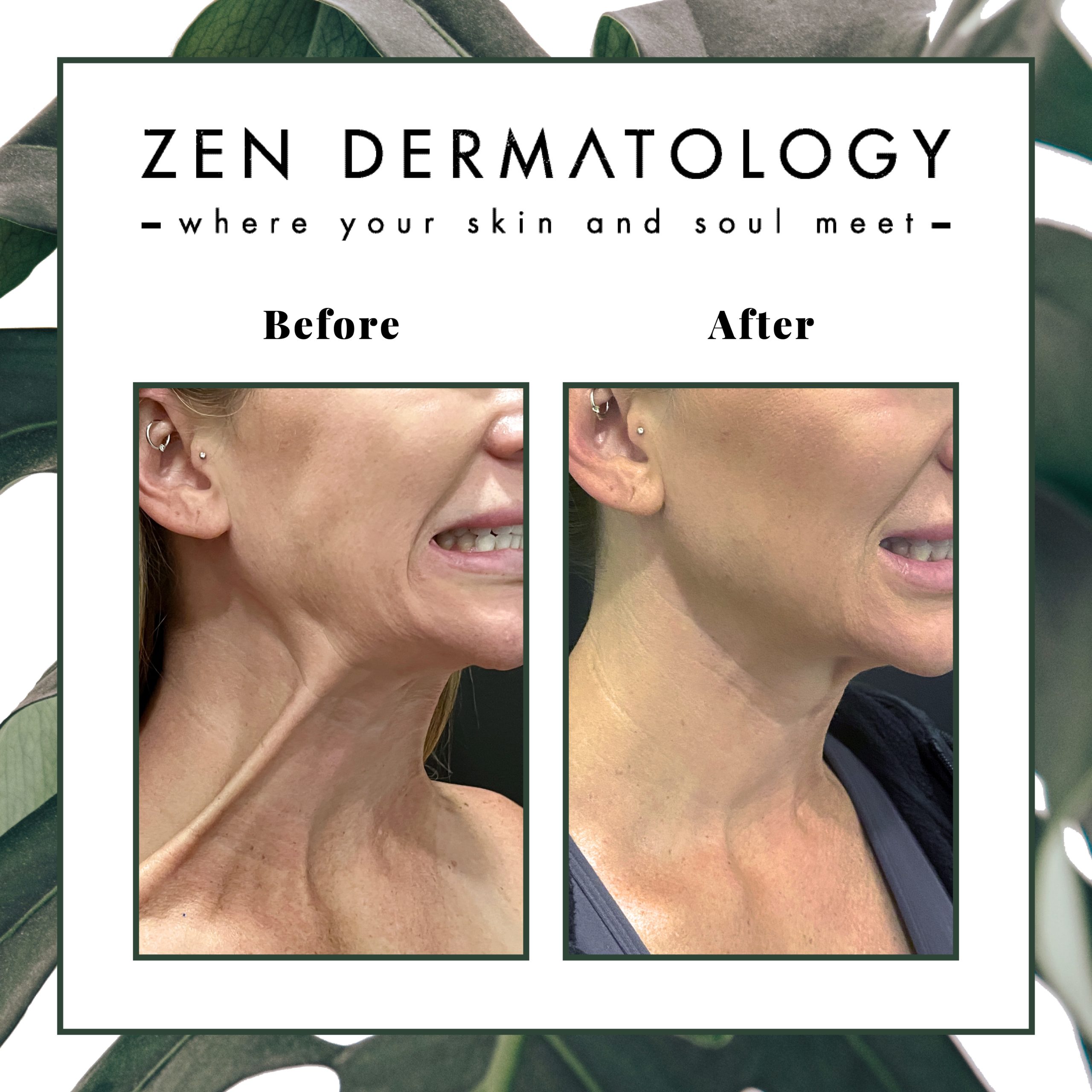Botox for Platysmal before & after images by ZEN Dermatology in Sacramento, CA