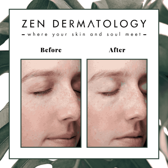 thermismooth-treatments before & after image by ZEN Dermatology in Sacramento, CA