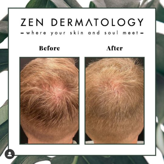 Fotona_Laser_PRP_Treatments before & after image by Zen Dermatology